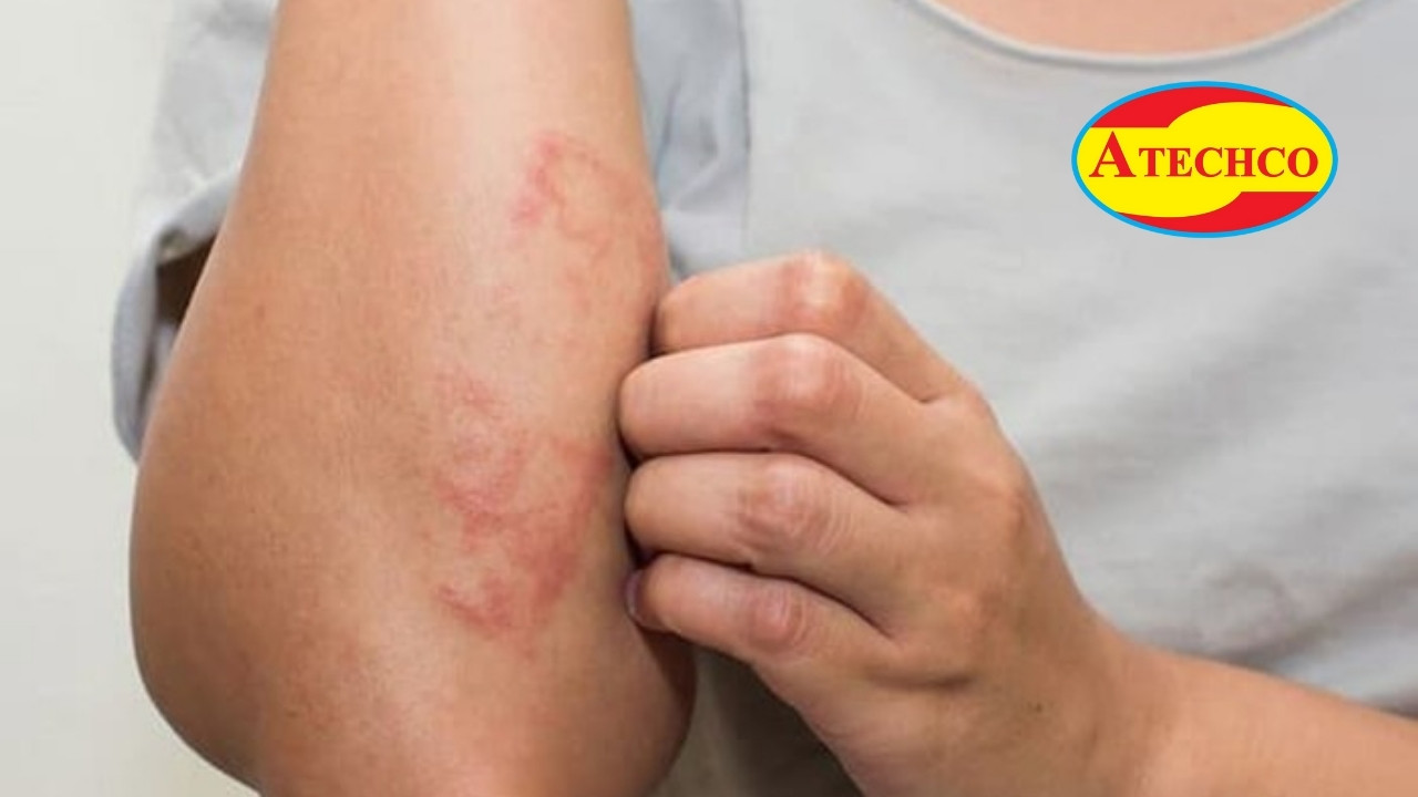 Lời khuy&ecirc;n khi gặp rết c&oacute; nọc độc mạnh