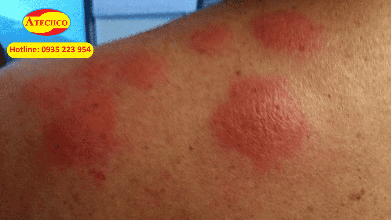 Dấu hiệu khi bị bọ x&iacute;t ch&iacute;ch